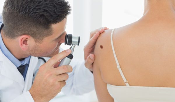 cura melanoma
